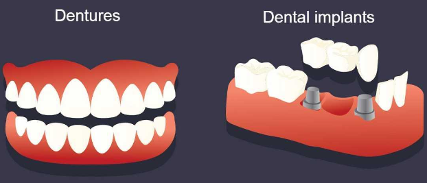 Dental Implants vs Dentures: 6 Key Differences to Know in 2026