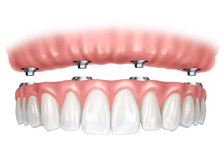 dental implants