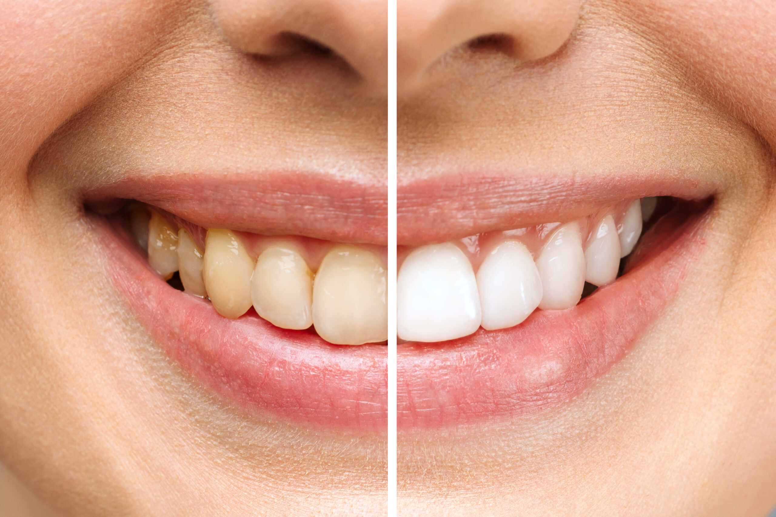 Professional Teeth Whitening in Albania: Everything You Should Know