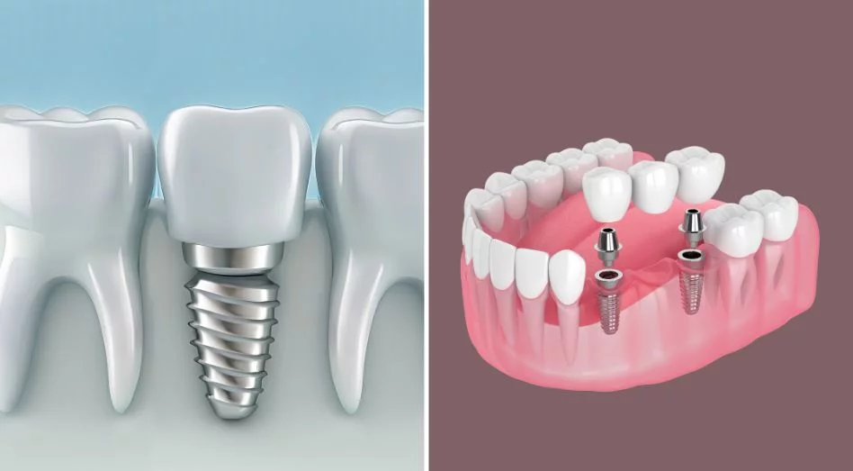 Dental Bridge vs. Implant Cost in Albania: Which Offers Better Value?