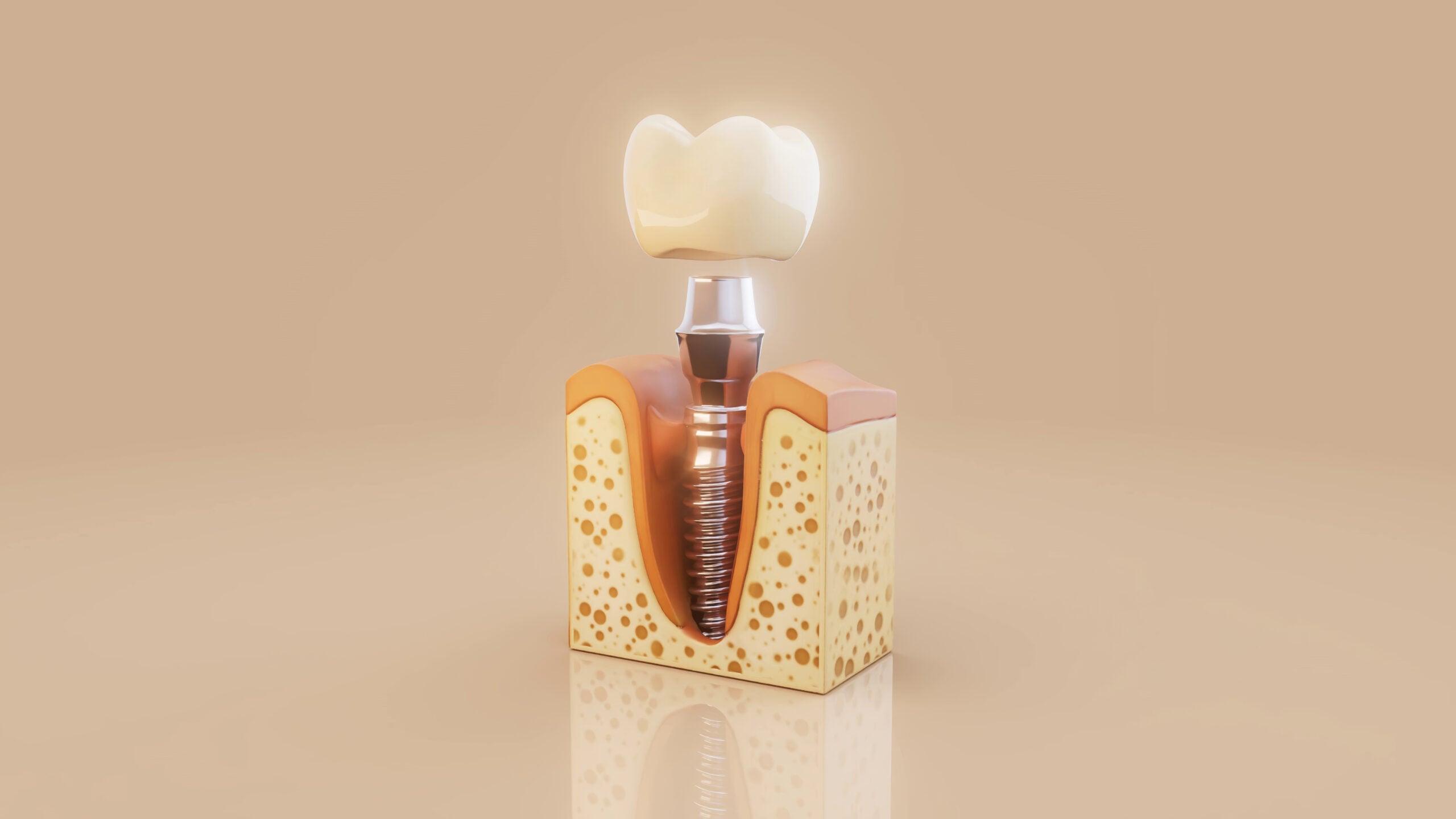 Dental Implants in Albania