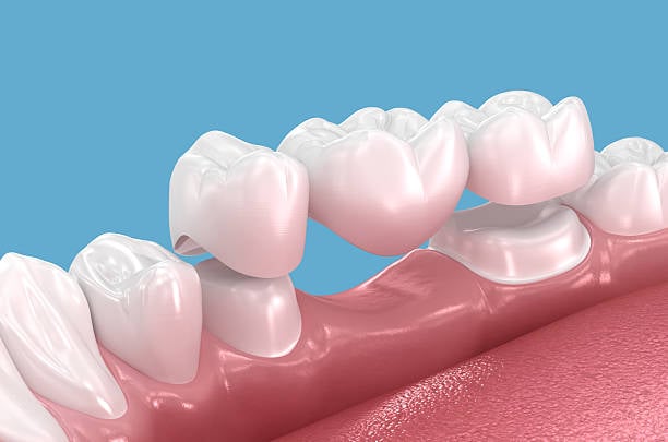 Dental Bridge