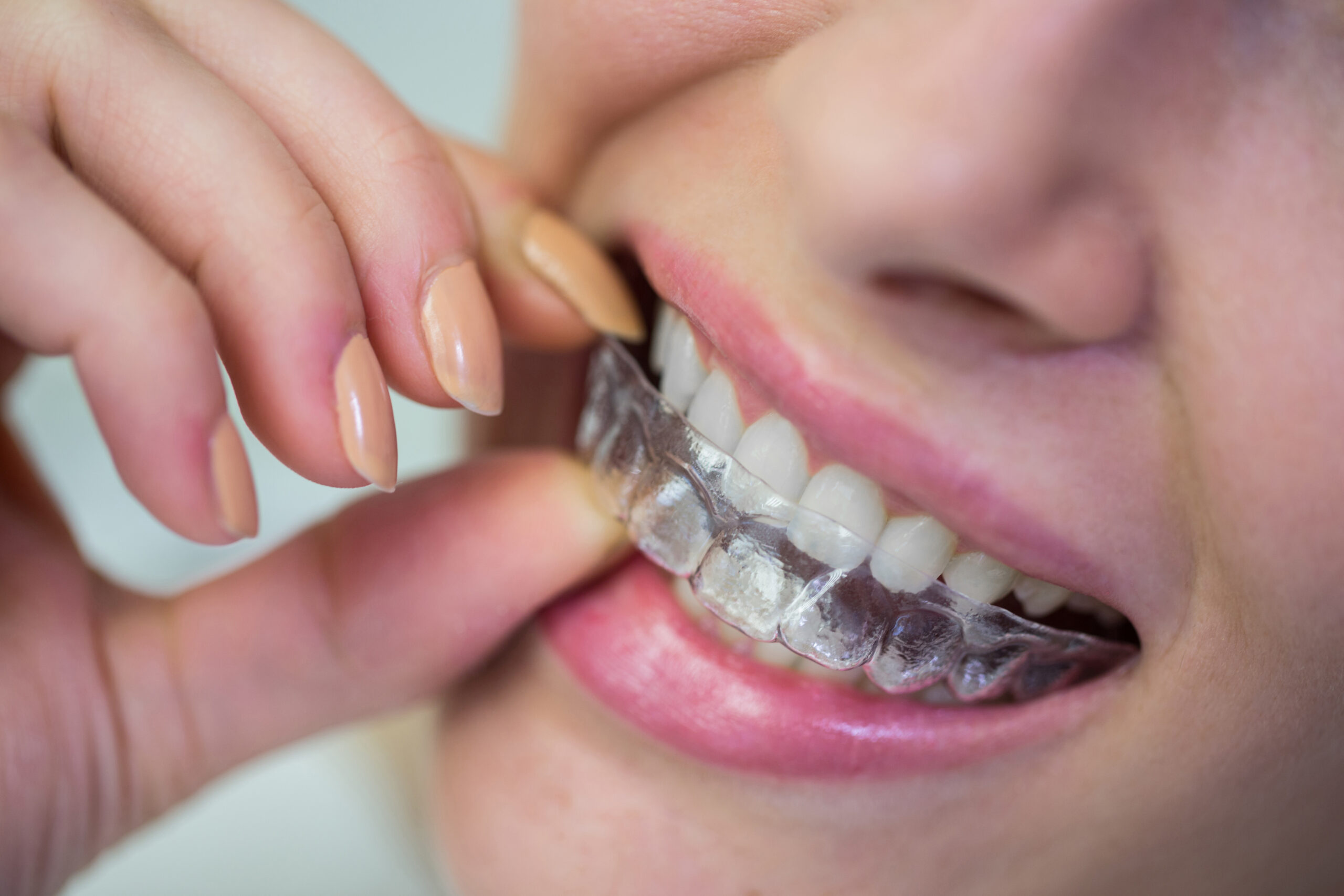 Invisalign in Albania