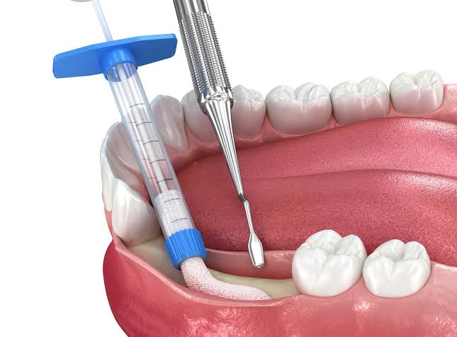 Bone Grafting for Dental Implants: Is It Necessary?
